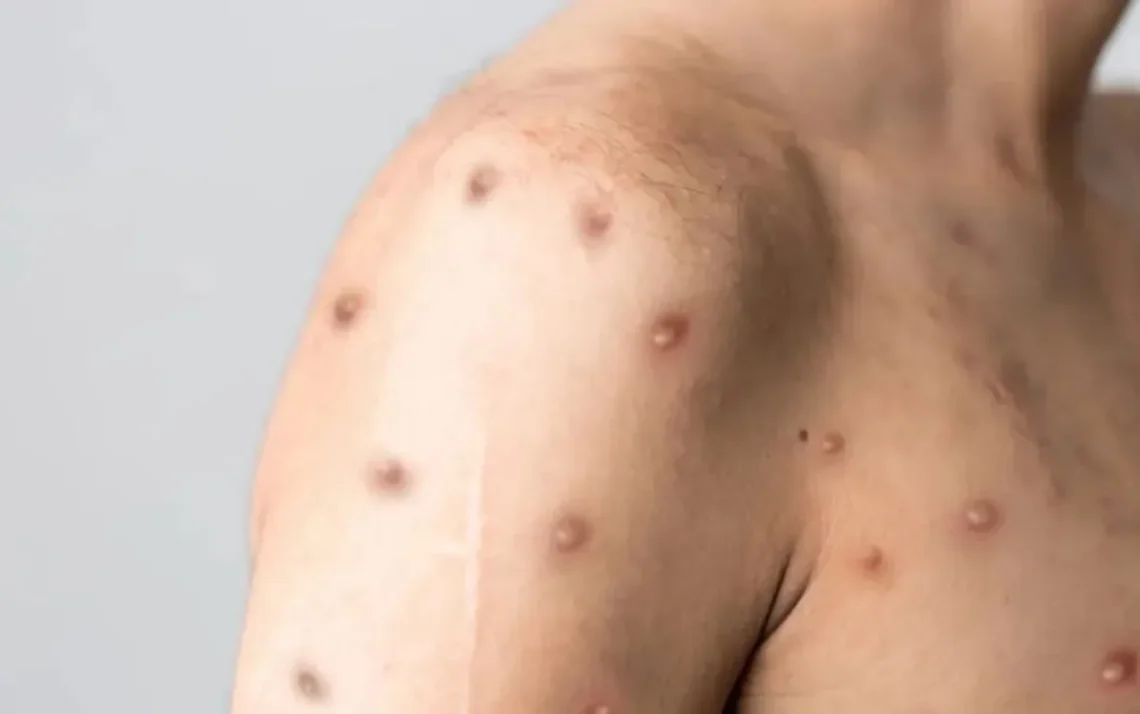 vírus, doença, infecção;