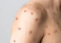 vírus, doença, infecção;