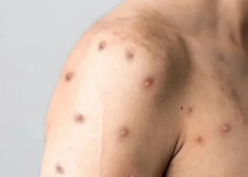 vírus, doença, infecção;